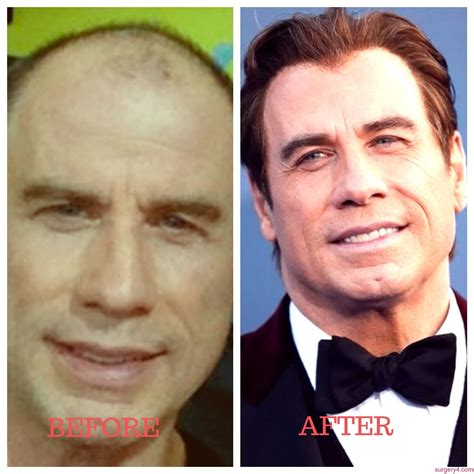 john travolta face lift|John Travolta Plastic Surgery: Before and After His Botox and。